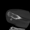 SPORK, NICO - 22.03.1976 - 02.08.2022 - CT obere Extremität - 17:59:38